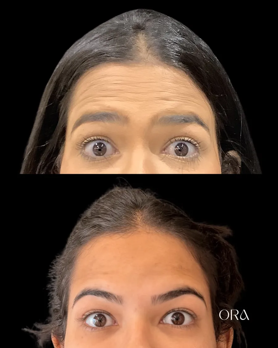 Antes e depois de paciente da Clínica ORA — vista frontal da região da testa