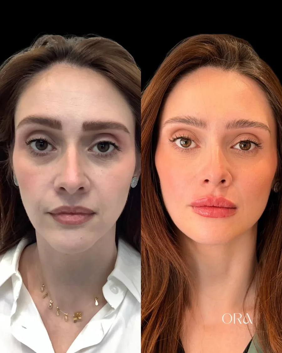 Antes e depois de paciente da Clínica ORA — retrato frontal do rosto
