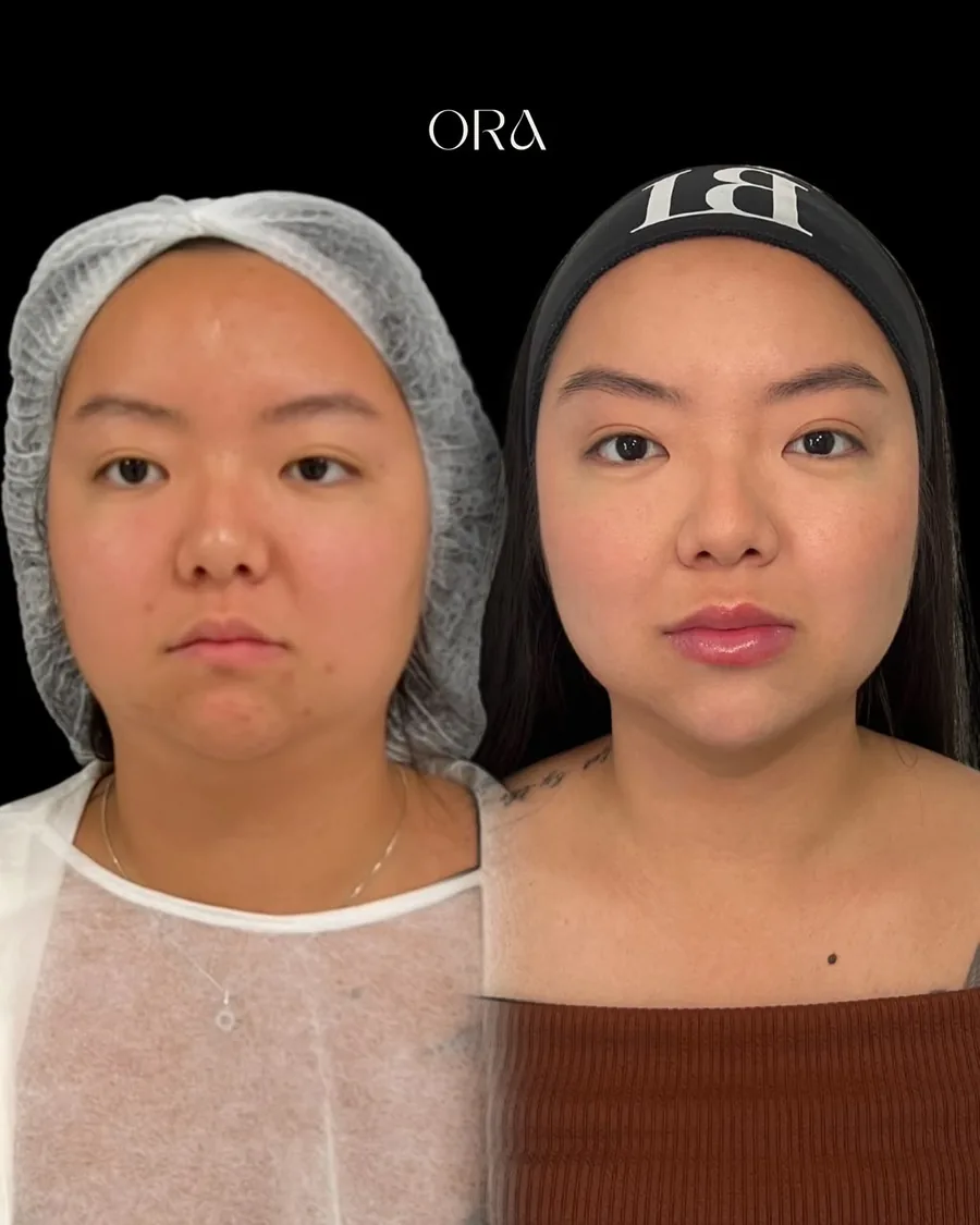 Antes e depois de paciente da Clínica ORA — retrato frontal do rosto