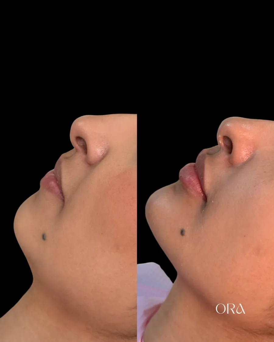 Antes e depois de paciente da Clínica ORA — perfil do queixo e da mandíbula
