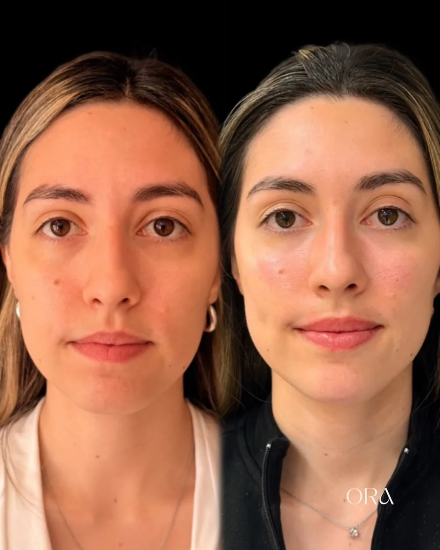 Antes e depois de paciente da Clínica ORA — retrato frontal do rosto