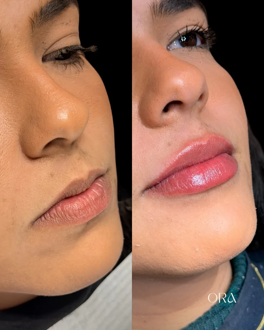 Antes e depois de paciente da Clínica ORA — perfil dos lábios