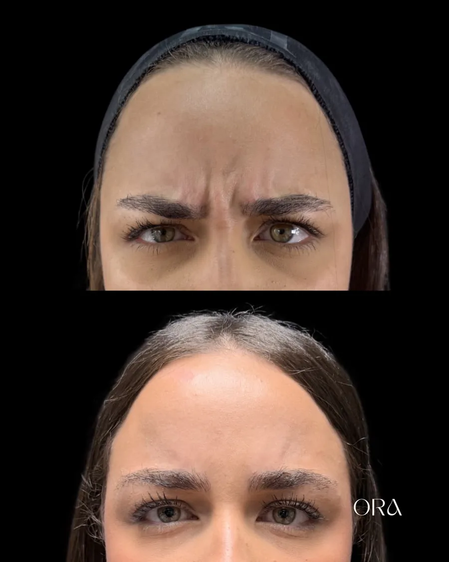 Antes e depois de paciente da Clínica ORA — vista frontal da região da testa