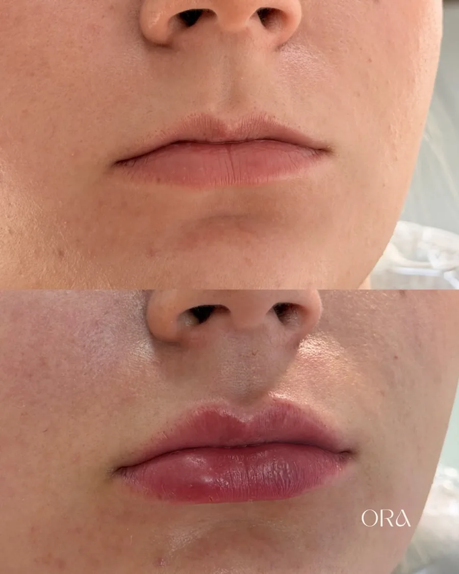 Antes e depois de paciente da Clínica ORA — detalhe dos lábios