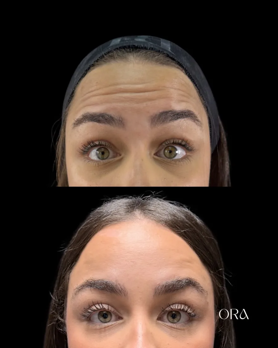 Antes e depois de paciente da Clínica ORA — vista frontal da região da testa