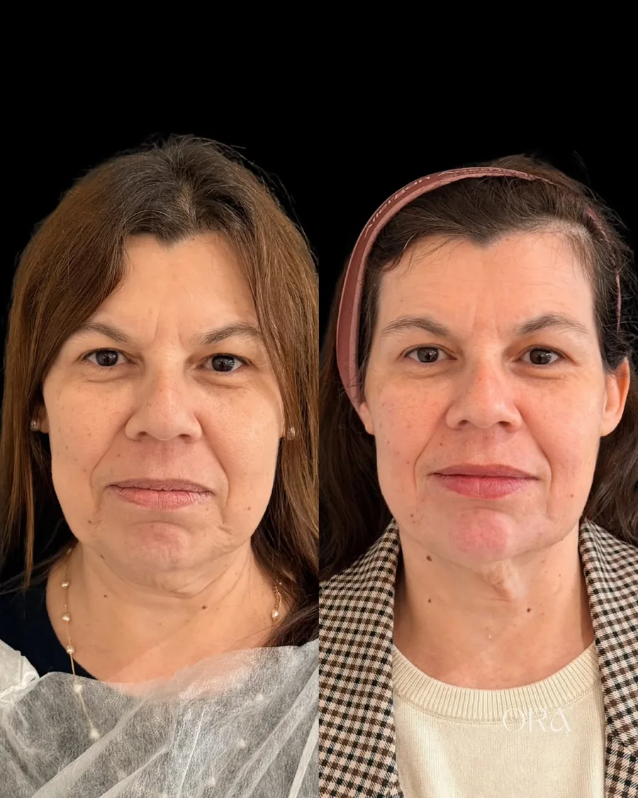 Antes e depois de paciente da Clínica ORA — retrato frontal do rosto