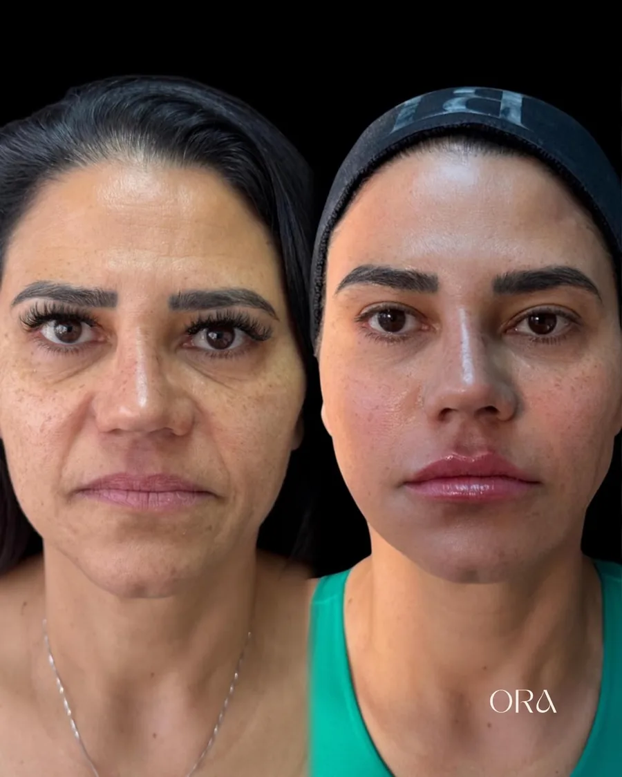 Antes e depois de paciente da Clínica ORA — retrato frontal do rosto