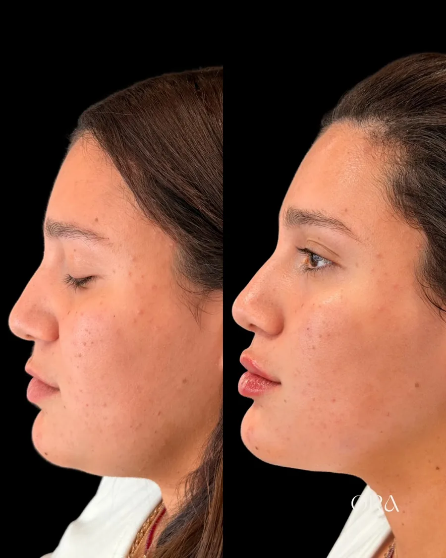 Antes e depois de paciente da Clínica ORA — perfil do rosto