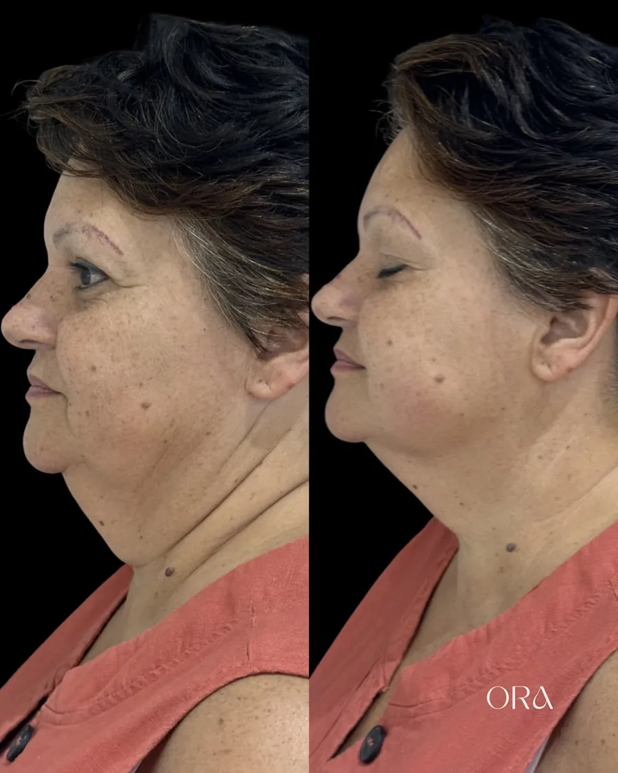 Antes e depois de paciente da Clínica ORA — perfil da mandíbula e do pescoço