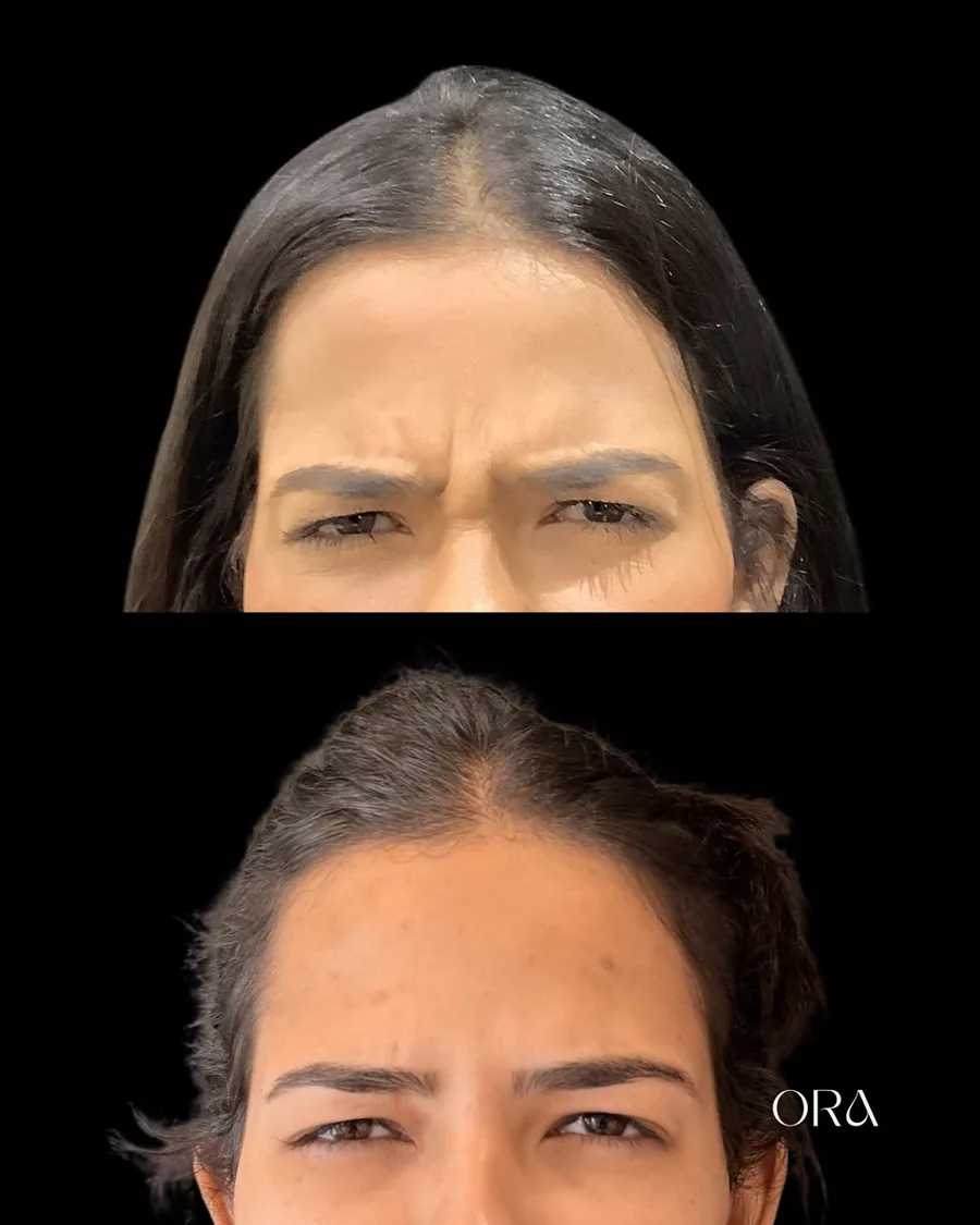 Antes e depois de paciente da Clínica ORA — vista frontal da região da testa
